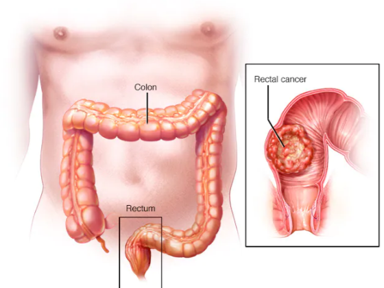 piles surgery in chennai