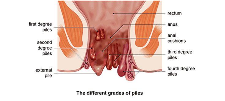 piles surgery in chennai