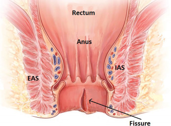 piles surgery in chennai