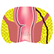 fistula treatment