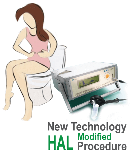 Laser Piles treatment